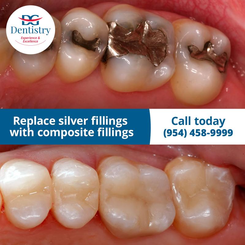 Replace silver fillings with composite fillings