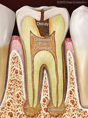 Una sección transversal que muestra una infección de caries dental que se propaga hacia la pulpa y el hueso en el extremo de las raíces.