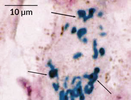 Tissue from the brain of an 84-year-old woman who died of Alzheimer’s disease shows evidence of infection with an oral species of Trepemona (dark blue). G.R. RIVIERE, K.H. RIVIERE, K.S. SMITH/ORAL MICROBIOL. IMMUNOL. 2002