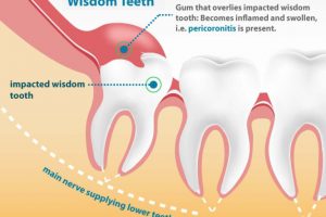 Wisdom Tooth Extraction