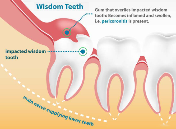 non impacted wisdom teeth