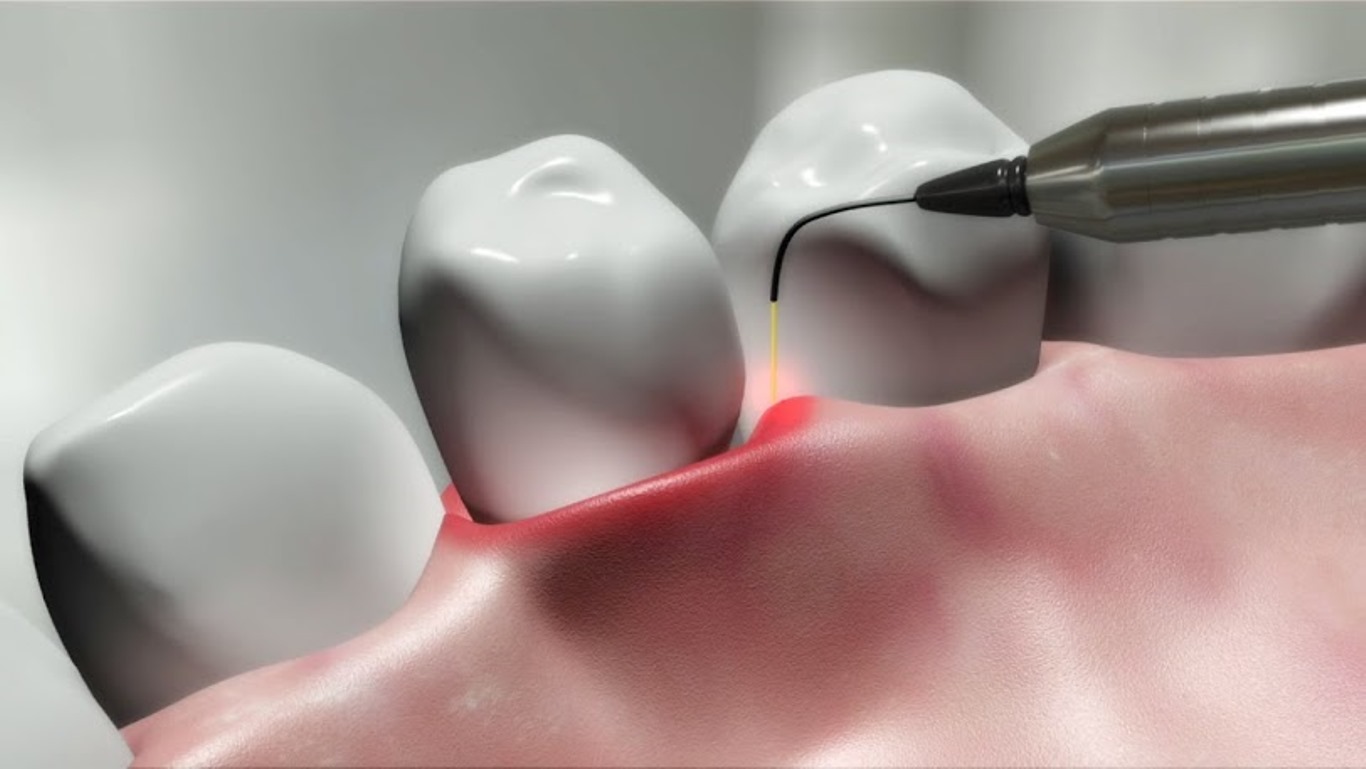 Лазерное десен. Лазер в хирургической стоматологии. Хирургическая ретракция десны. Лазерная терапия в стоматологии.