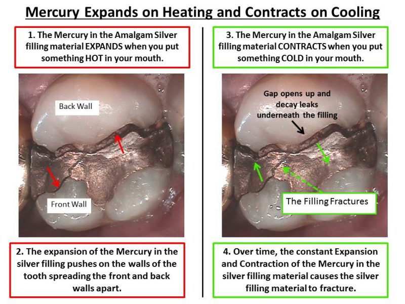 amalgam fillings mercury poisoning
