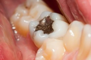 Killer In Your Mouth: Remove Amalgam Fillings And You Will Be Healed Of Many Diseases