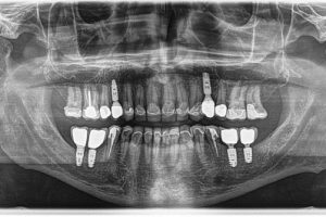 Dental Implants: What You Need to Know Before You Go