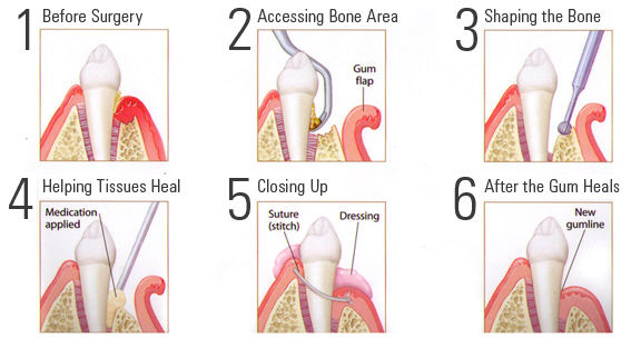 Kelsey Periodontal Group  Deep Cleaning of Teeth - Kelsey Periodontal Group