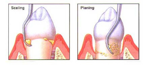 What Is A Deep Cleaning At The Dentist