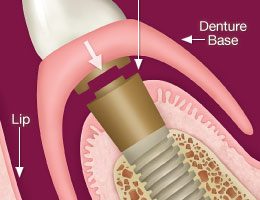 denture-attaches-to-implants