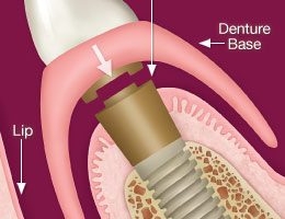 прикрепление протеза к имплантам