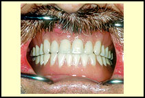 Patient wearing final upper and lower dentures