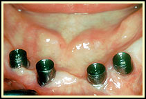 Standard abutments connected to the tops of the implants