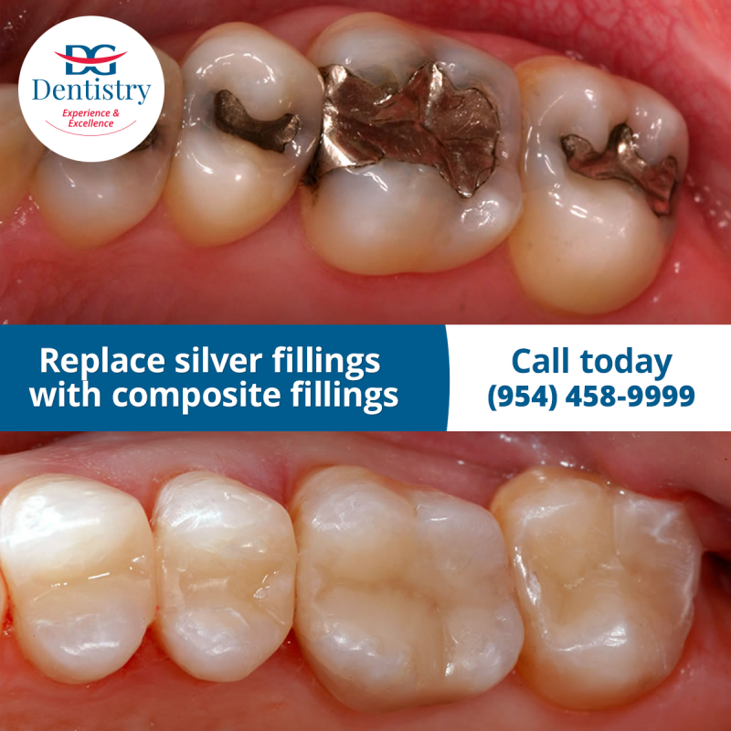 Tooth-colored Composite Fillings To Replace Silver