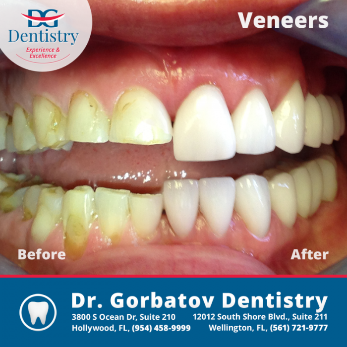 how-much-does-a-smile-makeover-cost-gorbatov-dentistry-your