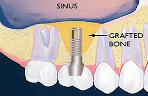 Bone Grafting and Closed Sinus Lift Gorbatov Dentistry Your