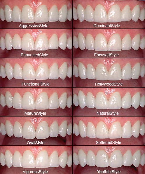 Choosing The Perfect Shaped Porcelain Veneers Gorbatov Dentistry | Free ...