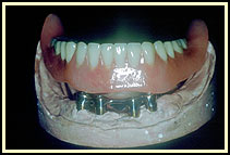 The denture is being seated on the implants and bar