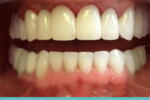 Veneers and the 10 most common mistakes