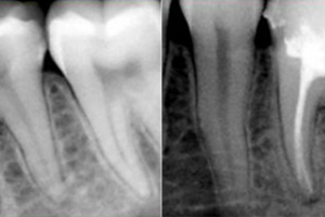 How to Prepare for Root Canal Therapy