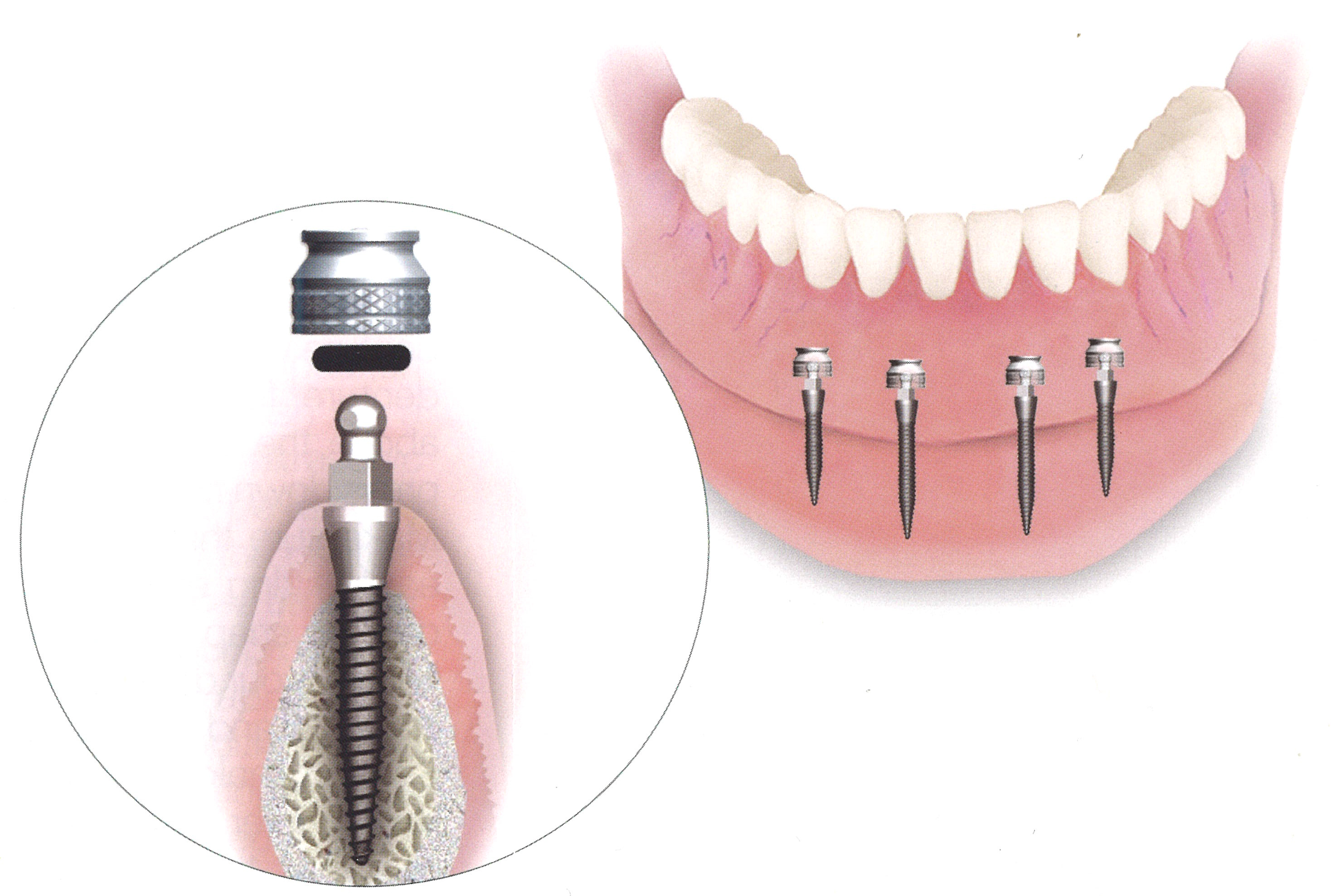 how do mini dental implants work