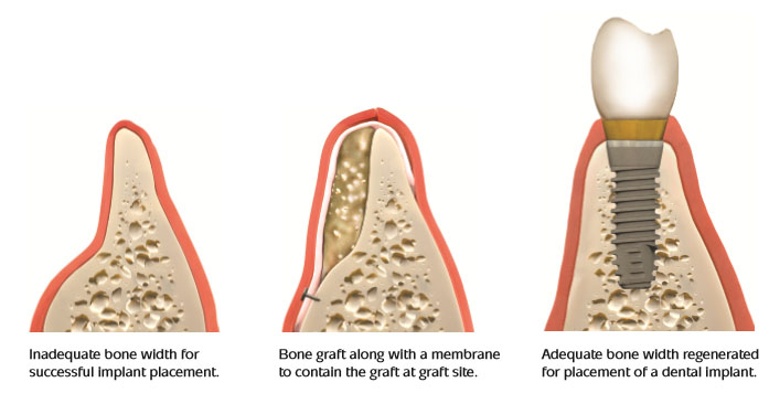 Bone grafting procedure