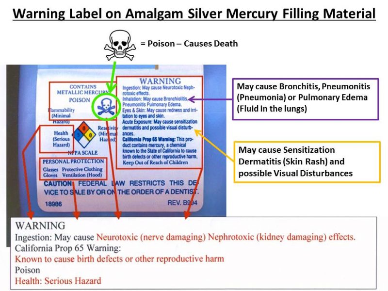 What is Amalgam Filling?